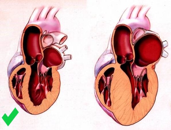 Pulsactive prevén a hipertrofia ventricular